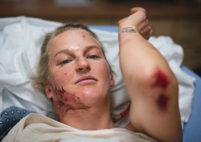 Emily Harrington shows her injuries
